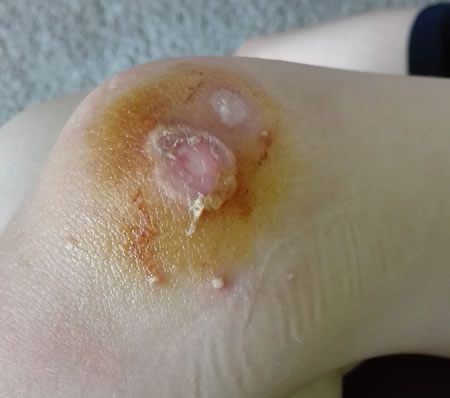 infectie purulenta infectie purulenta