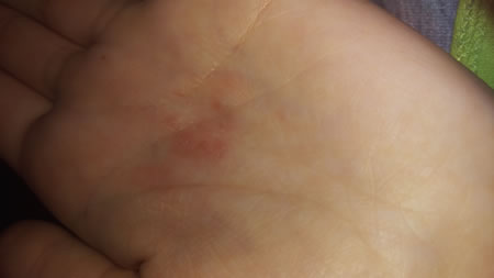 eczema dishidrotica