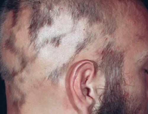 Caderea Parului sau Alopecia