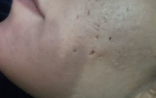 acnee nodulo chistica