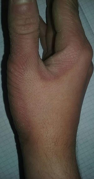 boala piele mana boala piele mana