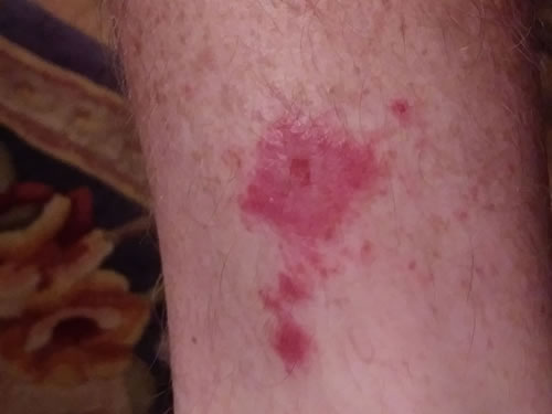 eczema